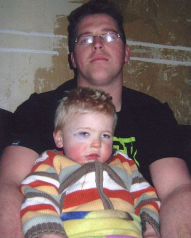 Josh Hodkins cu ochiul invinetit in urma unui accident