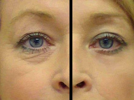 Plasturi hidrogel pentru ochi cu colagen, efect anti-cearcane, Beauty Face