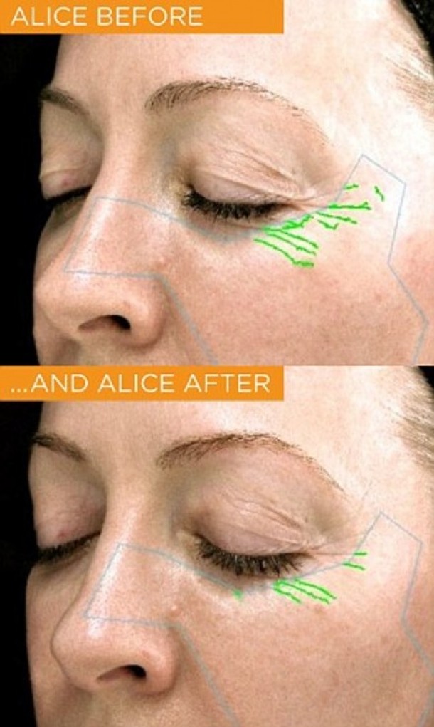 Inainte si dupa folosirea cremei