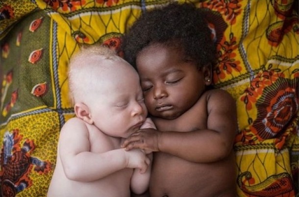 Nou nascut de 3 saptamani care sufera de albinism, doarme cu varul sau din Kinshasa, Congo. Poza de Patricia Willocq
