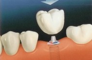implant dentar