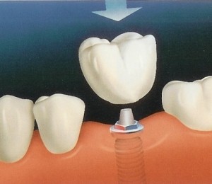 implant dentar