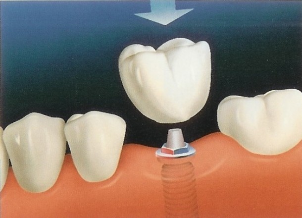 implant dentar