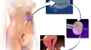 fertilizare in vitro