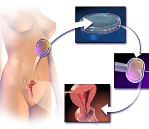 fertilizare in vitro