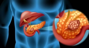 cancer pancreatic