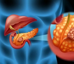 cancer pancreatic